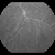 Retinal Vasculitis Retinal Vasculitis